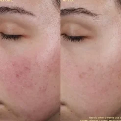 Blemish Control Moisturizer - Fuktkräm som motverkar ojämnheter