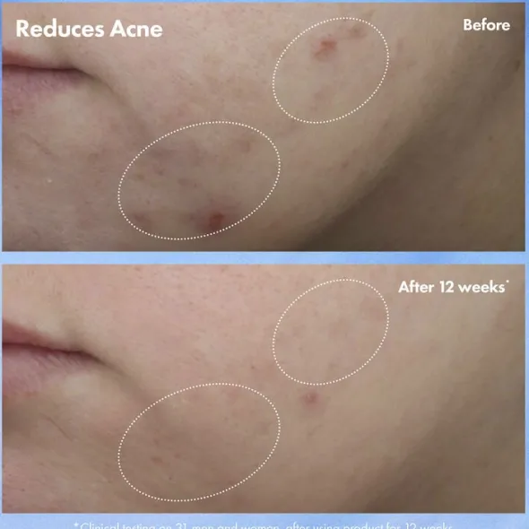Clear Improvement Acne & Blackhead Clearing Hydrating Moisturizer Loti